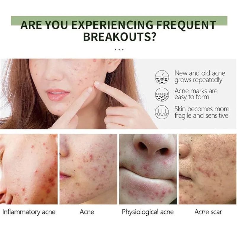 Acne Removal Cream Anti-Acne Repair Redness Pimple Spots Gel Deep Cleaning Pore Oil Control Moisturizing Skin Care