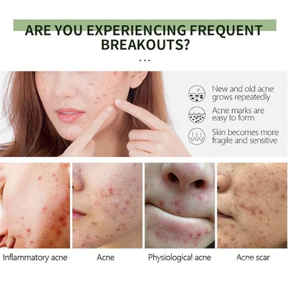 Acne Removal Cream Anti-Acne Repair Redness Pimple Spots Gel Deep Cleaning Pore Oil Control Moisturizing Skin Care