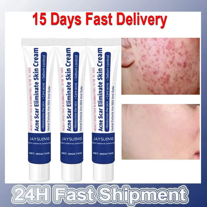 Herbal Anti-Acne Face Treatment Cream Blackhead Clears Pimple Scar Oil Control Shrink Pores Whitening Skincare Korean Cosmetics