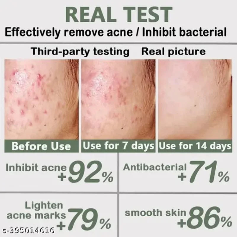 Acne Removal Cream Anti-Acne Repair Redness Pimple Spots Gel Deep Cleaning Pore Oil Control Moisturizing Skin Care