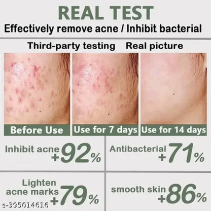 Acne Removal Cream Anti-Acne Repair Redness Pimple Spots Gel Deep Cleaning Pore Oil Control Moisturizing Skin Care