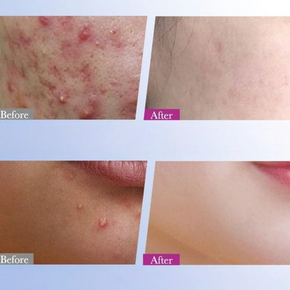 7/10/14Pcs Colorful Star Acne Patch Improve Women Skin Hydrocolloid Acne Tool Invisible Acne Cover Pimple Patch Skin Care Tools