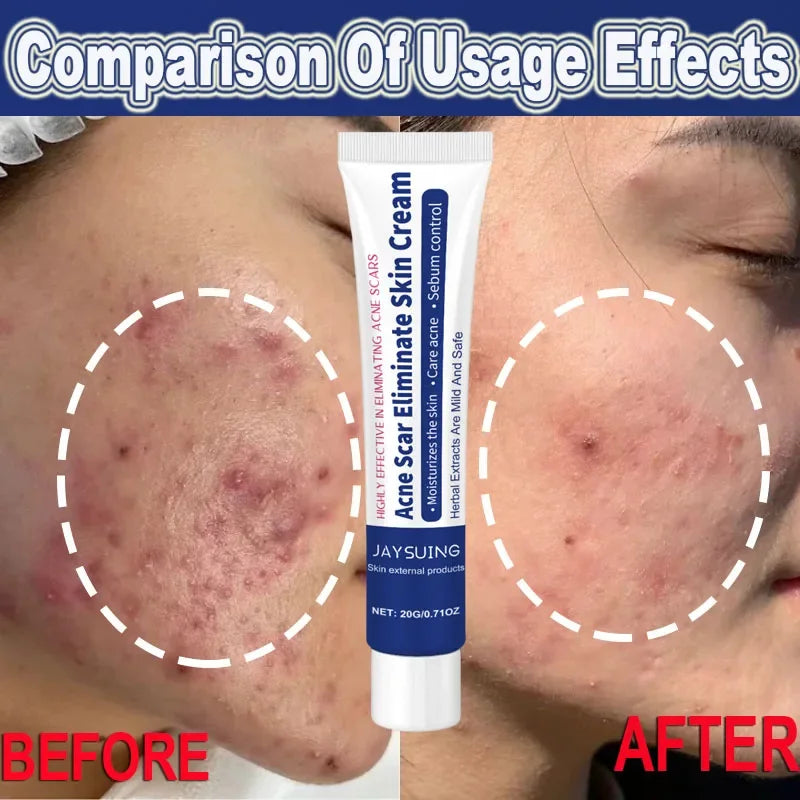 Herbal Anti-Acne Face Treatment Cream Blackhead Clears Pimple Scar Oil Control Shrink Pores Whitening Skincare Korean Cosmetics