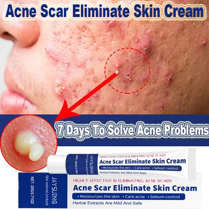 Herbal Anti-Acne Face Treatment Cream Blackhead Clears Pimple Scar Oil Control Shrink Pores Whitening Skincare Korean Cosmetics