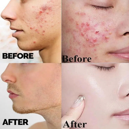 Herbal Anti-Acne Face Treatment Cream Blackhead Clears Pimple Scar Oil Control Shrink Pores Whitening Skincare Korean Cosmetics