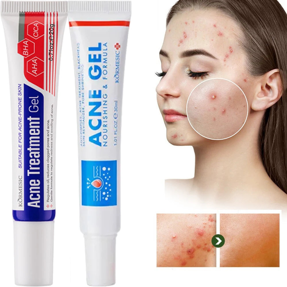 Acne Removal Cream Anti-Acne Repair Redness Pimple Spots Gel Deep Cleaning Pore Oil Control Moisturizing Skin Care