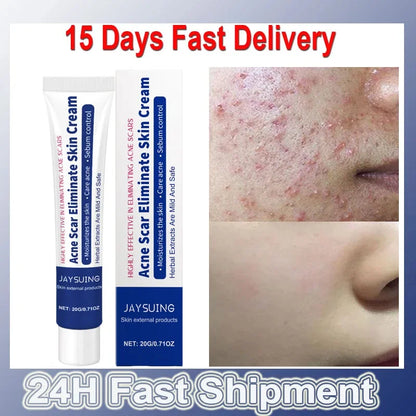 Herbal Anti-Acne Face Treatment Cream Blackhead Clears Pimple Scar Oil Control Shrink Pores Whitening Skincare Korean Cosmetics